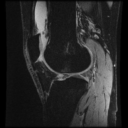 File:Anterior cruciate ligament tear (Radiopaedia 61500-69462 F 59).jpg