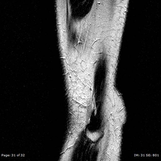 File:Anterior cruciate ligament tear (Radiopaedia 70783-80964 Sagittal T2 31).jpg
