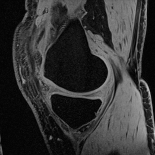 Anterior cruciate ligament tear - ramp lesion (Radiopaedia 71883-82322 Sagittal T1 vibe 100).jpg