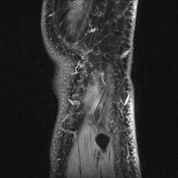Anterior cruciate ligament tear - ramp lesion (Radiopaedia 71883-82322 Sagittal T1 vibe 11).jpg