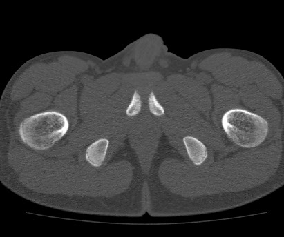Anterior inferior iliac spine avulsion fracture (Radiopaedia 81312-94999 Axial bone window 68).jpg