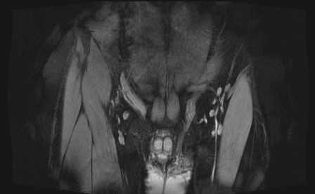 Anterior inferior iliac spine avulsion fracture (Radiopaedia 81312-95000 G 102).jpg