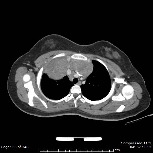 Anterior mediastinal B cell Lymphoma (Radiopaedia 50677-56114 A 17).jpg