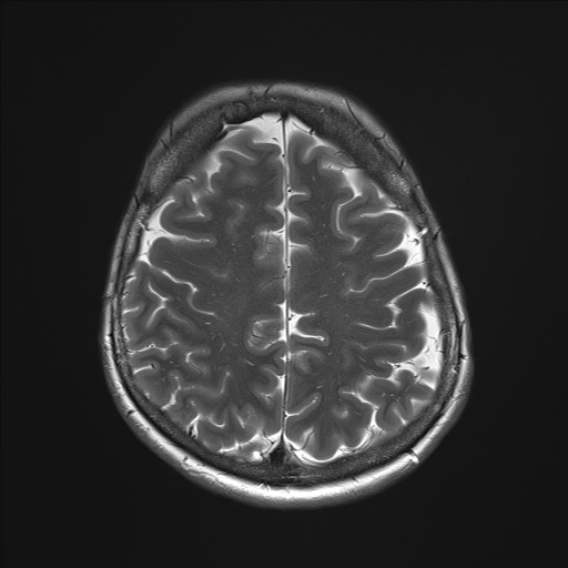 File:Anterior temporal encephalocele (Radiopaedia 82624-96808 Axial T2 30).jpg
