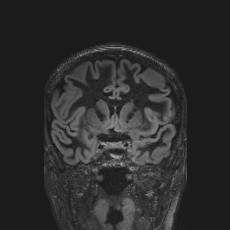 Anterior temporal encephalocele (Radiopaedia 82624-96808 Coronal FLAIR 19).jpg