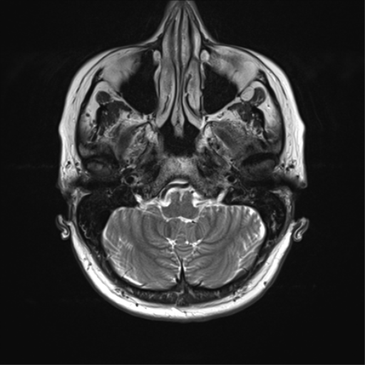 File:Anterior temporal lobe perivascular space (Radiopaedia 40946-43650 Axial T2 7).png