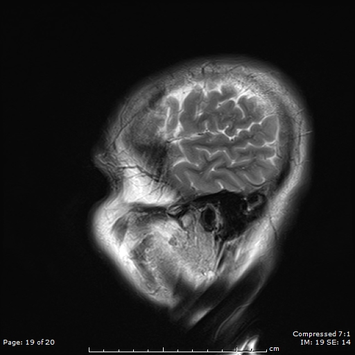 File:Anterior temporal lobe perivascular space (Radiopaedia 88283-104914 Sagittal T2 19).jpg