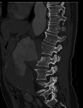 File:Anterior vertebral scalloping (abdominal aortic aneurysm) (Radiopaedia 66744-76067 Sagittal bone window 19).jpg