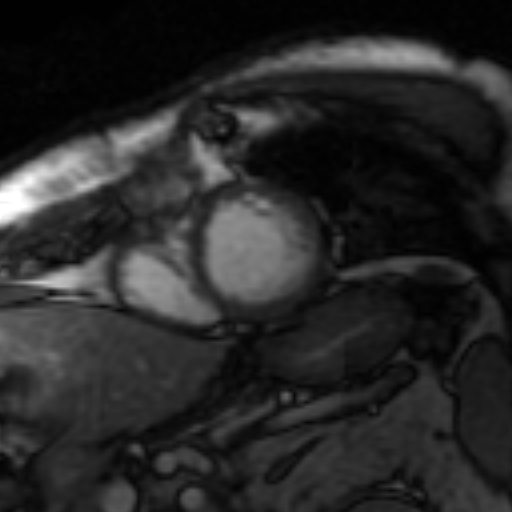 File:Anteroseptal hypokinesia after myocardial infarction (Radiopaedia 15978-15633 Short axis SSFE 1).jpg