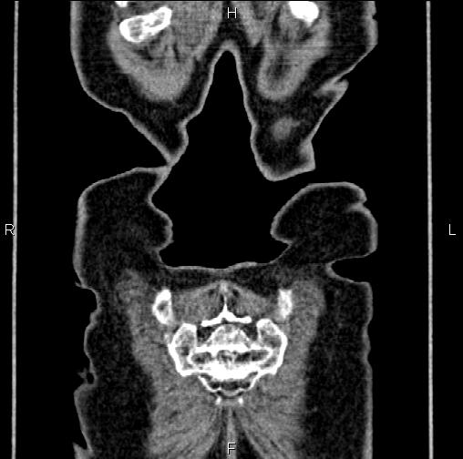 File:Aortic aneurysm and Lemmel syndrome (Radiopaedia 86499-102554 C 67).jpg