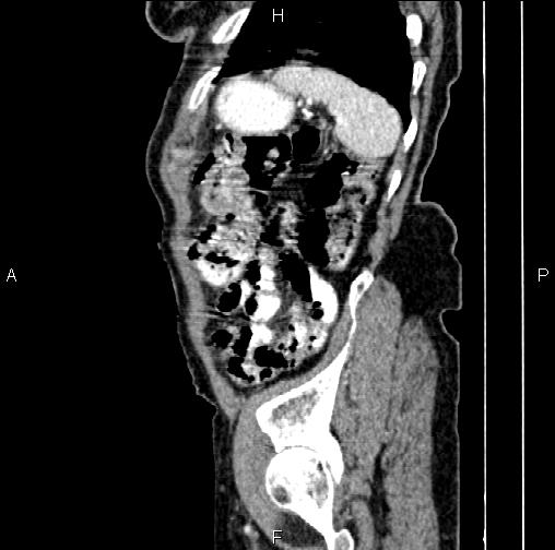 File:Aortic aneurysm and Lemmel syndrome (Radiopaedia 86499-102554 D 77).jpg