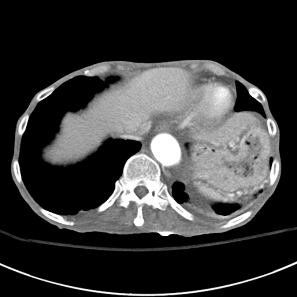 File:Aortic aneurysm with spinal destruction (Radiopaedia 42301-45410 A 11).jpg