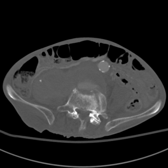 Aortic aneurysm with spinal destruction (Radiopaedia 42301-45410 Axial bone window 68).jpg