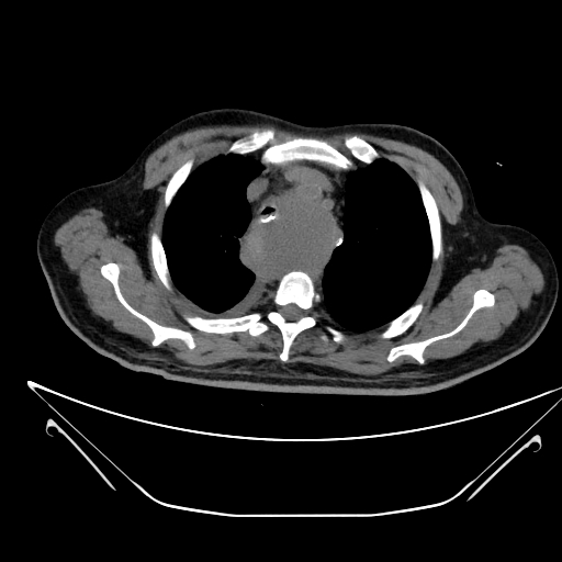 File:Aortic arch aneurysm (Radiopaedia 84109-99365 Axial non-contrast 71).jpg