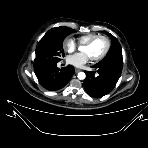 File:Aortic arch aneurysm (Radiopaedia 84109-99365 C 269).jpg