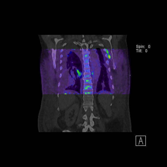Aortic arch graft infection (FDG PET-CT) (Radiopaedia 71975-82438 D 65).jpg
