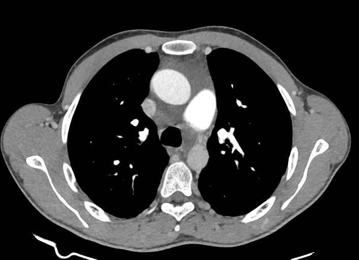 File:Aortic coarctation with aneurysm (Radiopaedia 74818-85828 A 134).jpg