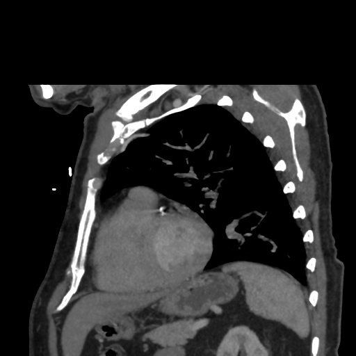 File:Aortic dissection- Stanford A (Radiopaedia 37759-39664 D 28).png