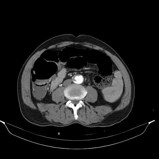Aortic dissection- Stanford type A (Radiopaedia 22085-22085 A 57).jpg