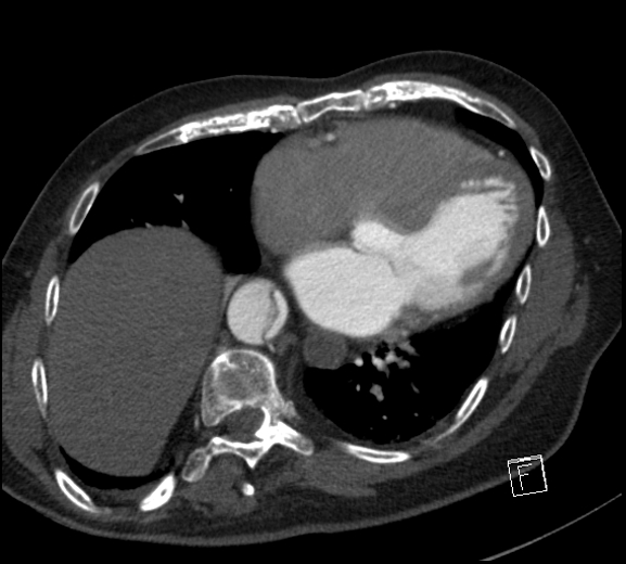 Aortic dissection (CTPA) (Radiopaedia 75506-86750 A 63).jpg