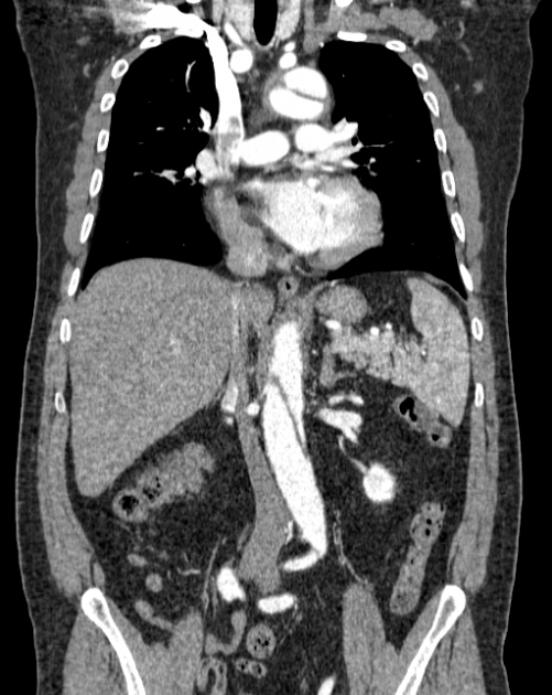 Aortic dissection (Radiopaedia 44411-48061 A 24).jpg