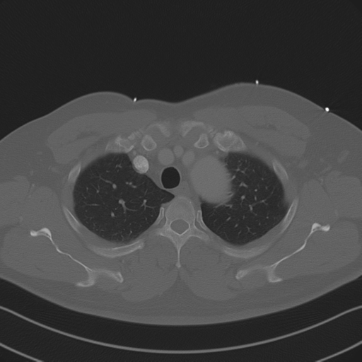 File:Aortic dissection (Radiopaedia 50763-56234 Axial bone window 26).png