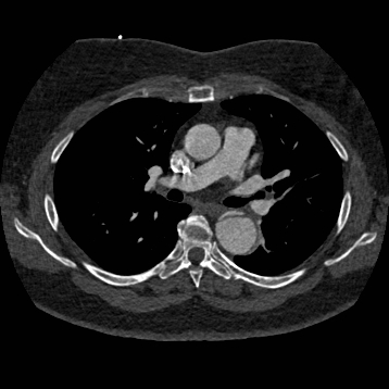 File:Aortic dissection (Radiopaedia 57969-64959 A 141).jpg