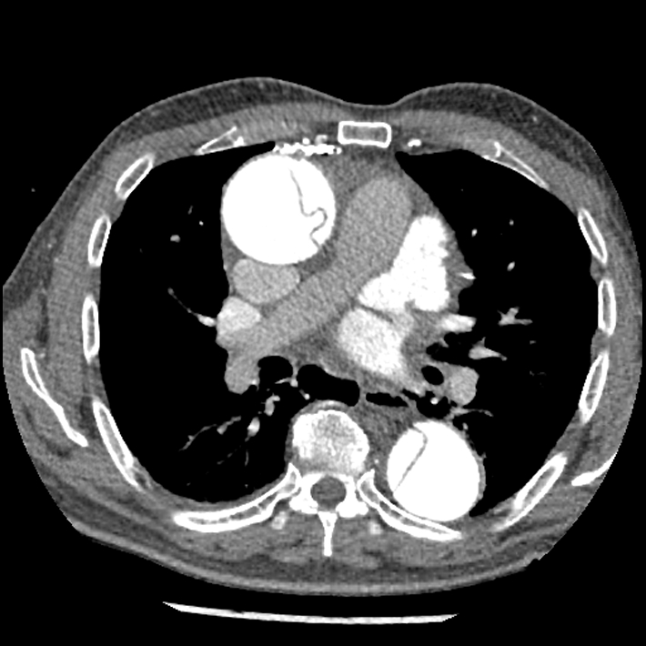 Aortic dissection - DeBakey Type I-Stanford A (Radiopaedia 79863-93115 A 18).jpg