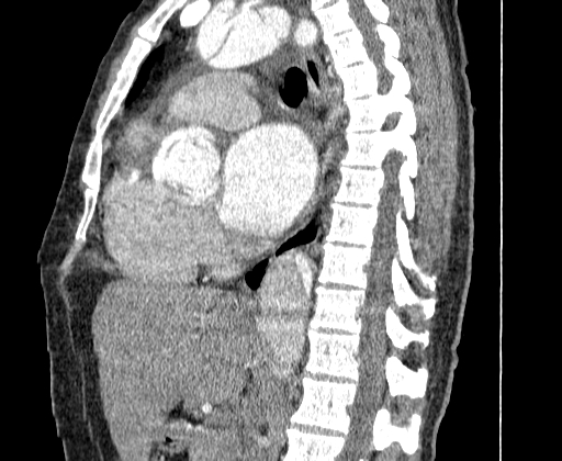 Aortic dissection - Stanford A -DeBakey I (Radiopaedia 28339-28587 C 29).jpg