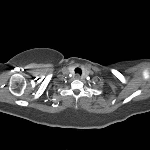 File:Aortic dissection - Stanford type A (Radiopaedia 39073-41259 A 2).png