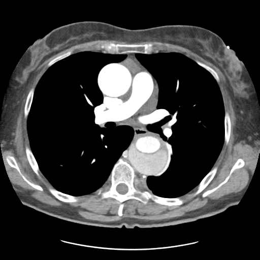 Aortic dissection - Stanford type B (Radiopaedia 50171-55512 A 23).png