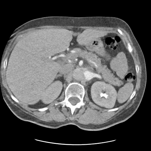File:Aortic dissection - Stanford type B (Radiopaedia 50171-55512 A 51).png