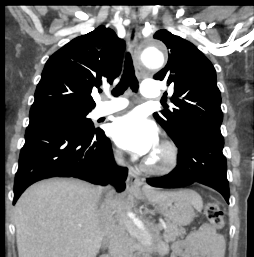 Aortic dissection - Stanford type B (Radiopaedia 50171-55512 B 43).png