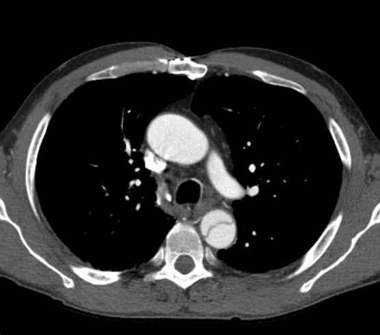 File:Aortic dissection - Stanford type B (Radiopaedia 73648-84437 A 33).jpg