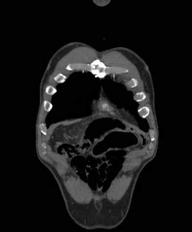 Aortic dissection - Stanford type B (Radiopaedia 73648-84437 B 13).jpg