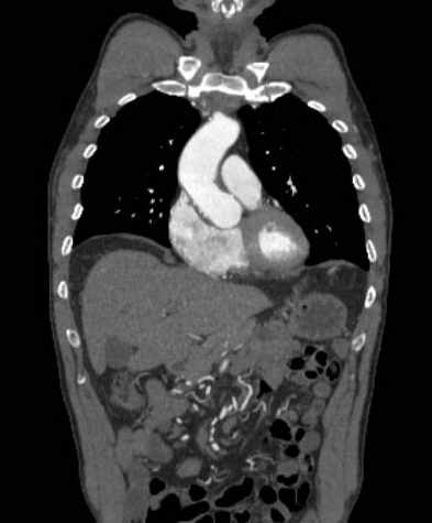 File:Aortic dissection - Stanford type B (Radiopaedia 73648-84437 B 40).jpg
