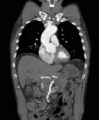 File:Aortic dissection - Stanford type B (Radiopaedia 73648-84437 B 44).jpg