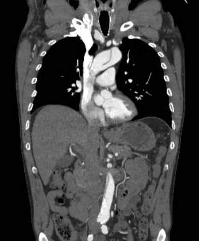 File:Aortic dissection - Stanford type B (Radiopaedia 73648-84437 B 53).jpg
