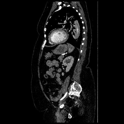 File:Aortic dissection - Stanford type B (Radiopaedia 88281-104910 C 62).jpg