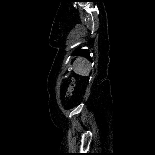 File:Aortic dissection - Stanford type B (Radiopaedia 88281-104910 C 78).jpg