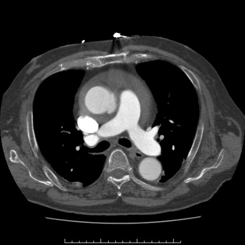 File:Aortic dissection with rupture into the pericardial sac (Radiopaedia 23726-23879 C+ arterial phase 3).jpg