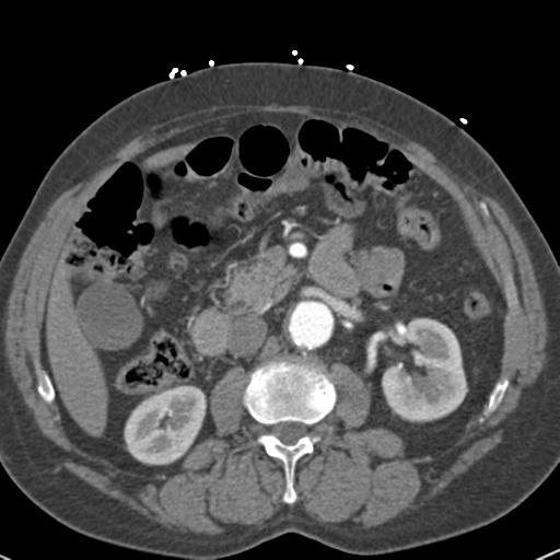 Aortic intramural hematoma (Radiopaedia 31139-31838 B 102).jpg