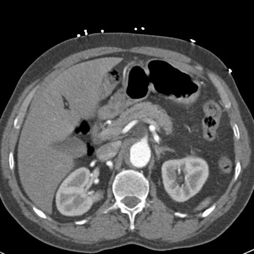 Aortic intramural hematoma (Radiopaedia 31139-31838 B 91).jpg