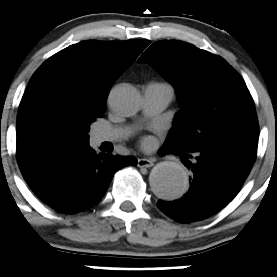 Aortic intramural hematoma (type B) (Radiopaedia 79323-92387 Axial non-contrast 26).jpg