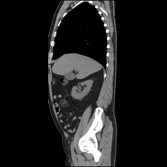 File:Aortic intramural hematoma (type B) (Radiopaedia 79323-92387 G 10).jpg