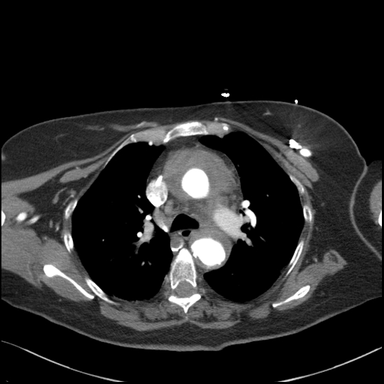 Aortic intramural hematoma with dissection and intramural blood pool (Radiopaedia 77373-89491 B 47).jpg