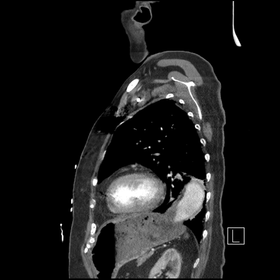 Aortic intramural hematoma with dissection and intramural blood pool (Radiopaedia 77373-89491 D 65).jpg