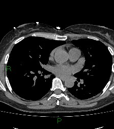 Aortic valve endocarditis (Radiopaedia 87209-103485 Axial non-contrast 55).jpg