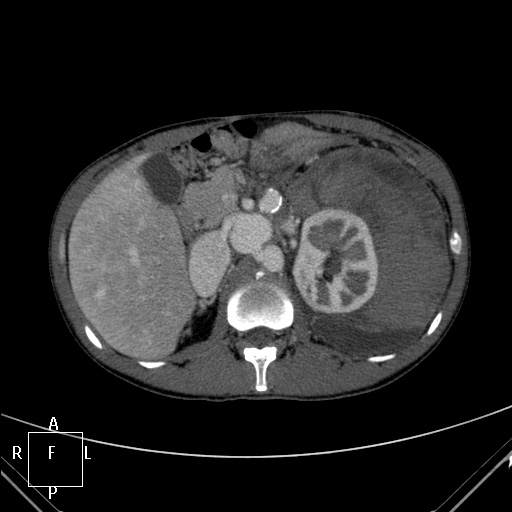 File:Aorto-left renal vein fistula (Radiopaedia 45534-49628 A 15).jpg