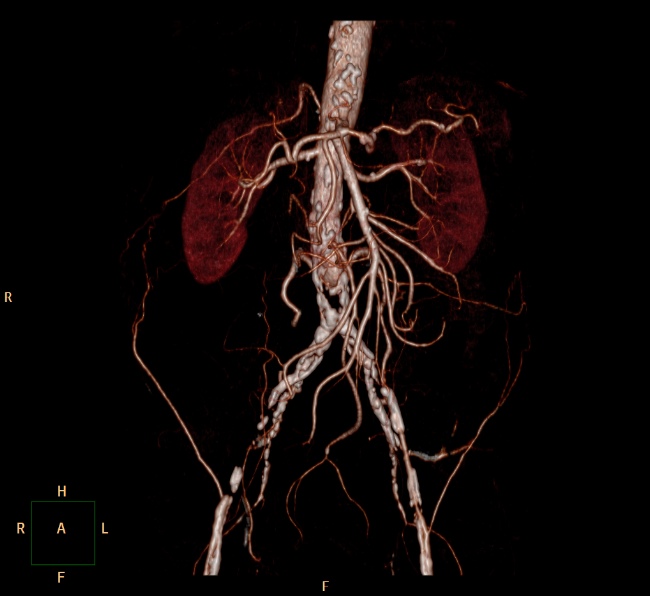 File:Aortoiliac occlusive disease (Radiopaedia 32134-33076 VR C+ arterial phase 1).jpg